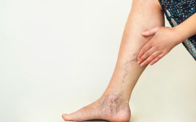 Natural Varicose vein treatment in ayurveda