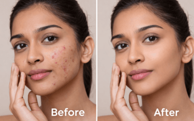 How to Remove Pimples Naturally at Home (Simple & Effective Remedies)